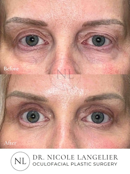 Female Upper and Lower Eyelid Blepharoplasty