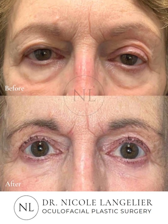 Female Upper and Lower Eyelid Blepharoplasty