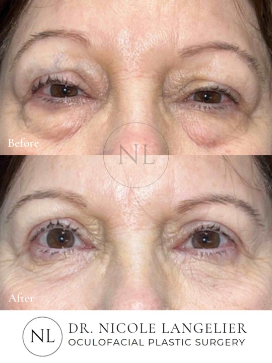 Female Upper and Lower Eyelid Blepharoplasty
