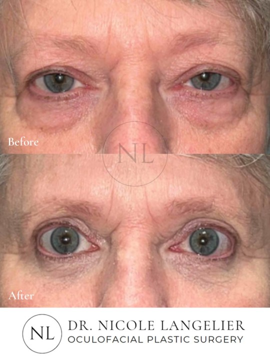 Female Upper and Lower Eyelid Blepharoplasty