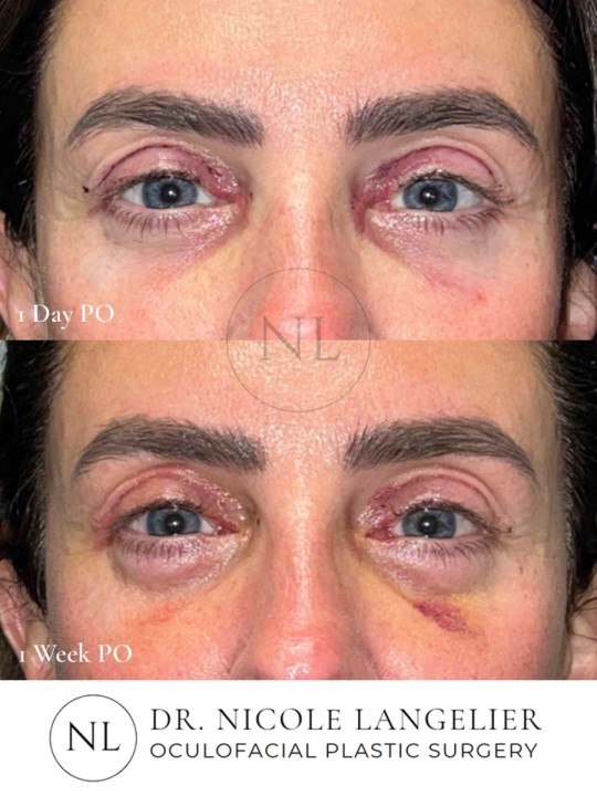 Female Upper and Lower Eyelid Blepharoplasty