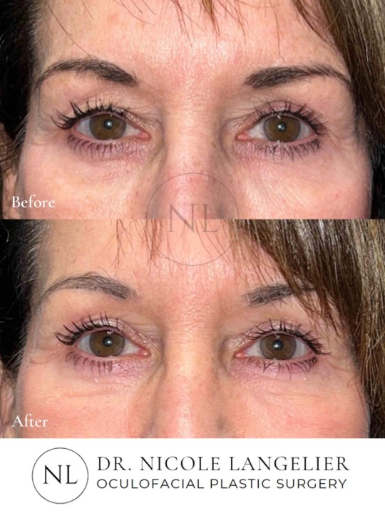 Female Upper and Lower Eyelid Blepharoplasty