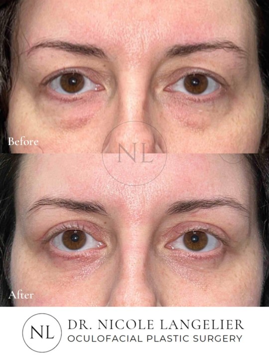 Female Upper and Lower Eyelid Blepharoplasty
