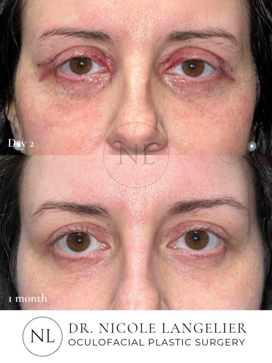 Female Upper and Lower Eyelid Blepharoplasty