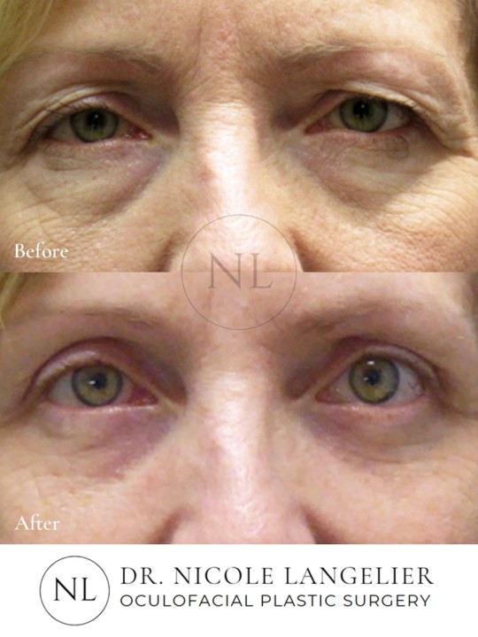 Female Upper and Lower Eyelid Blepharoplasty