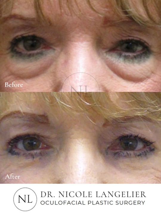 Female Upper and Lower Eyelid Blepharoplasty