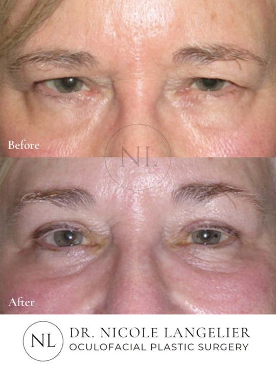 Female Upper and Lower Eyelid Blepharoplasty