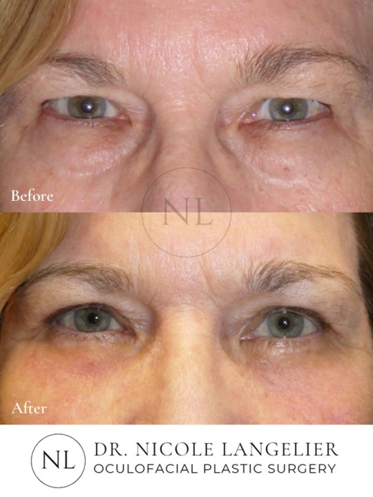 Female Upper and Lower Eyelid Blepharoplasty