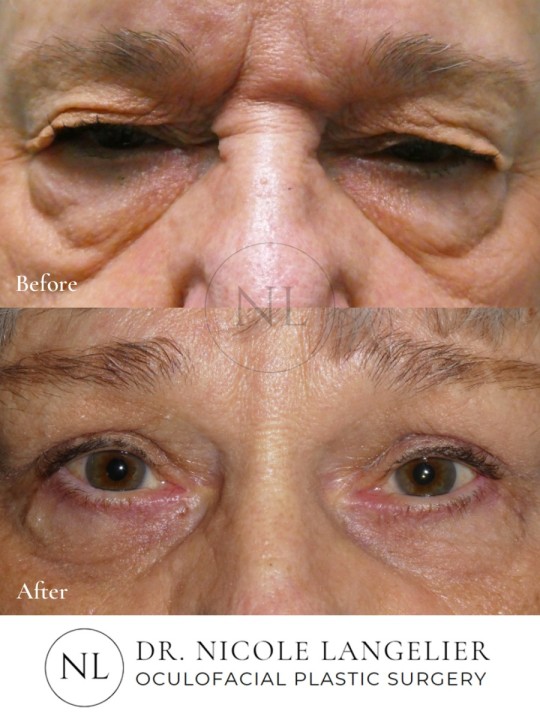 Female Upper and Lower Eyelid Blepharoplasty