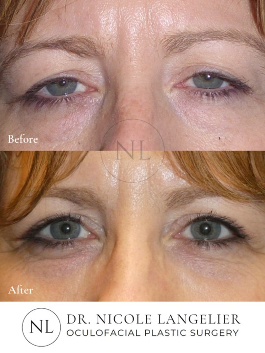 Female Upper and Lower Eyelid Blepharoplasty