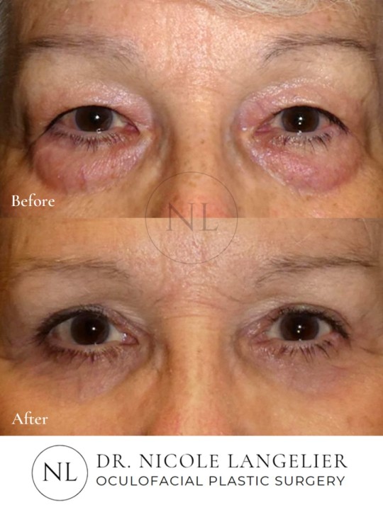 Female Upper and Lower Eyelid Blepharoplasty