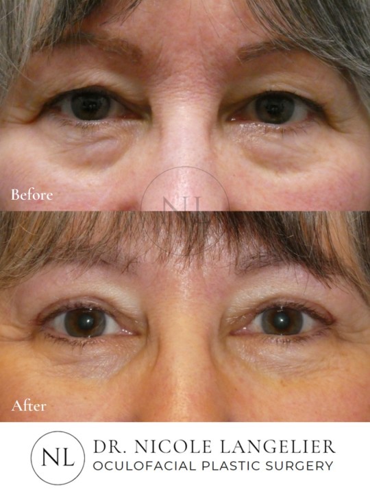 Female Upper and Lower Eyelid Blepharoplasty