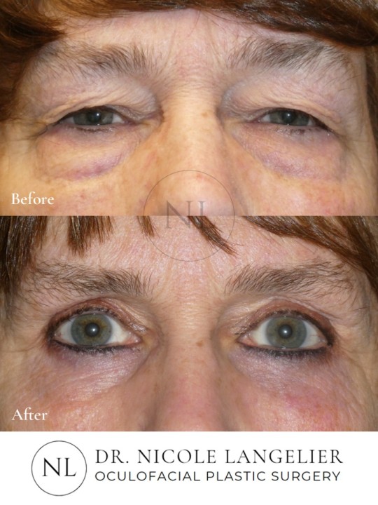 Female Upper and Lower Eyelid Blepharoplasty