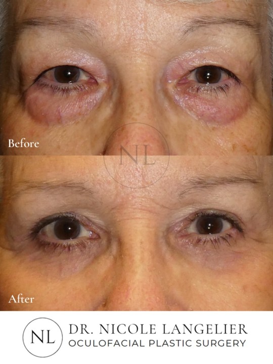 Female Upper and Lower Eyelid Blepharoplasty