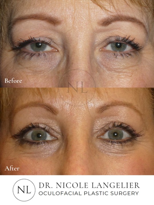 Female Upper and Lower Eyelid Blepharoplasty