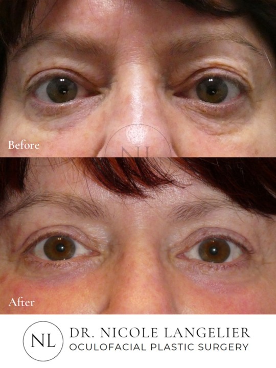 Female Upper and Lower Eyelid Blepharoplasty