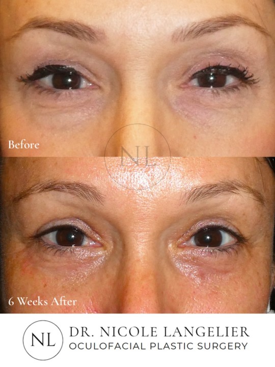 Female Upper and Lower Eyelid Blepharoplasty