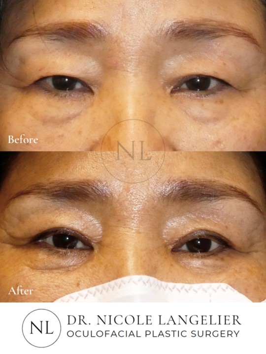 Female Upper and Lower Eyelid Blepharoplasty