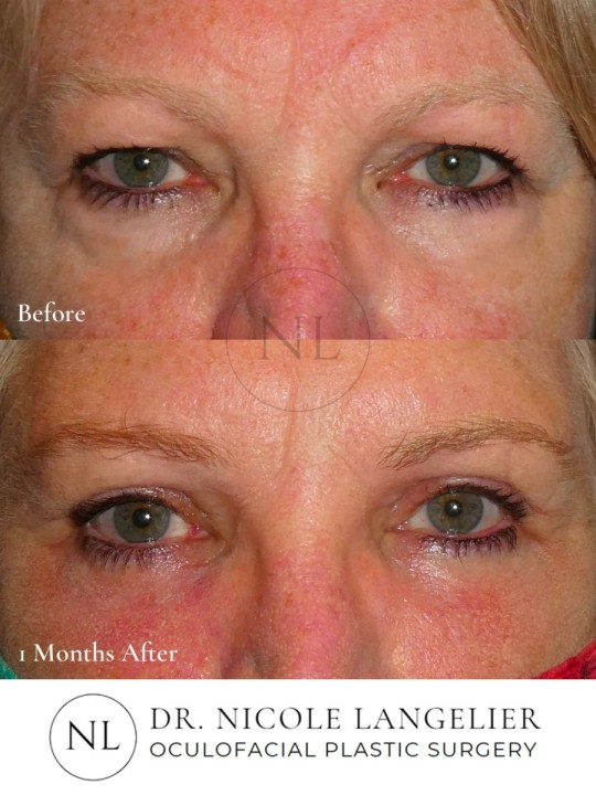 Female Upper and Lower Eyelid Blepharoplasty