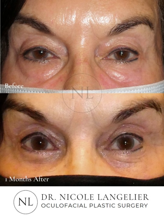 Female Upper and Lower Eyelid Blepharoplasty