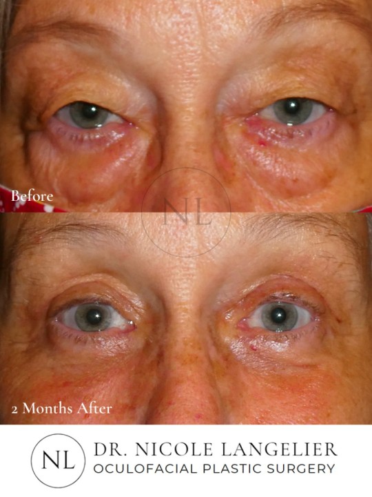 Female Upper and Lower Eyelid Blepharoplasty