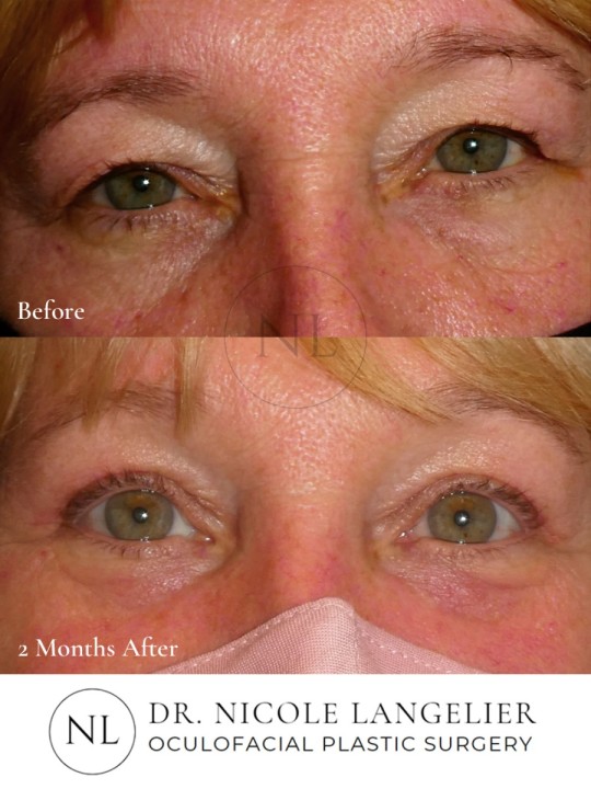 Female Upper and Lower Eyelid Blepharoplasty