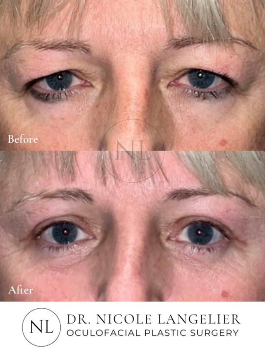Female Upper and Lower Eyelid Blepharoplasty