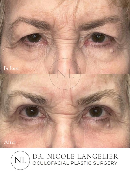Female Upper and Lower Eyelid Blepharoplasty