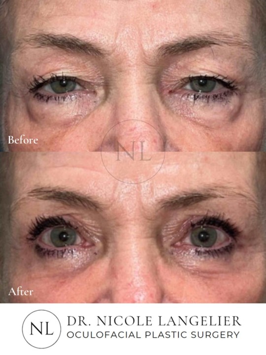 Female Upper and Lower Eyelid Blepharoplasty