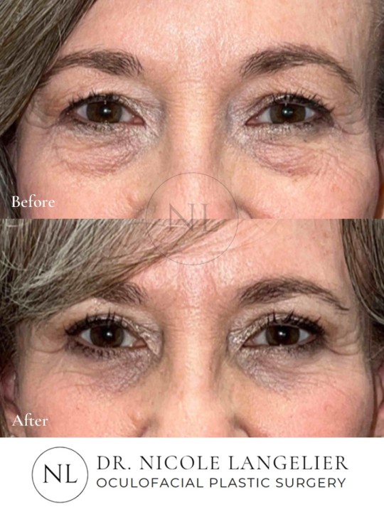 Female Upper and Lower Eyelid Blepharoplasty