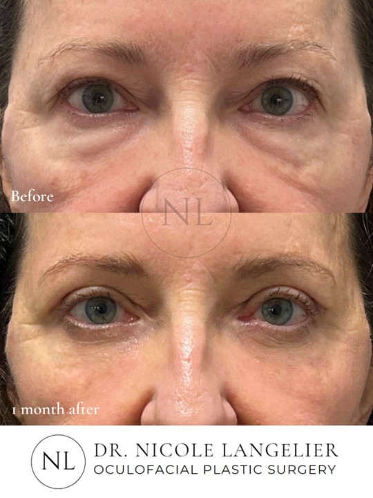 Female Upper and Lower Eyelid Blepharoplasty