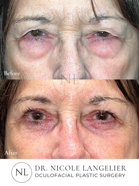 Female Upper Eyelid Before and After