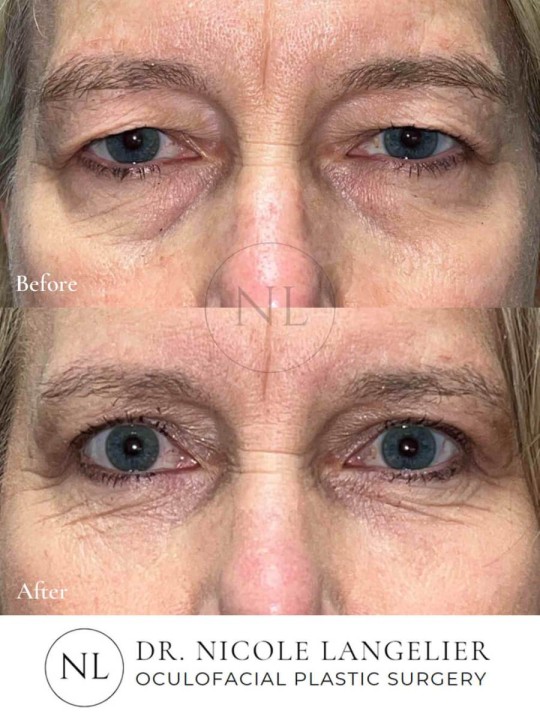 Female Upper and Lower Eyelid Blepharoplasty