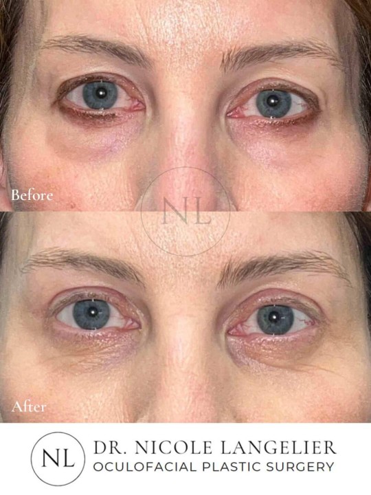 Female Upper and Lower Eyelid Blepharoplasty