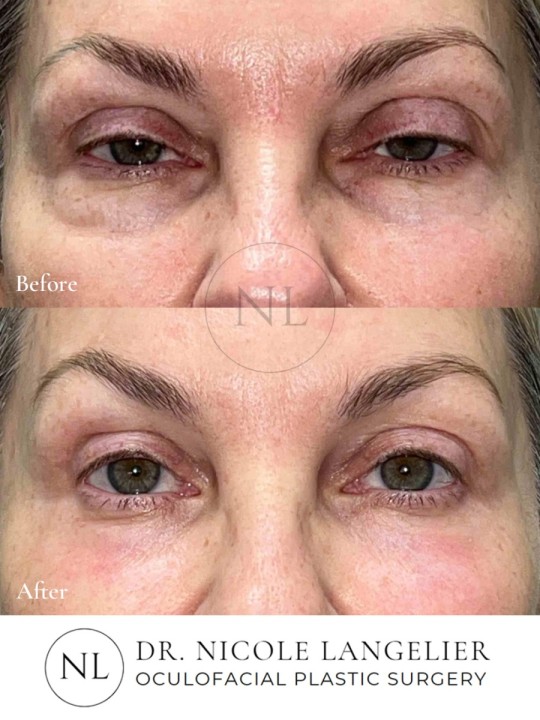 Female Upper and Lower Eyelid Blepharoplasty