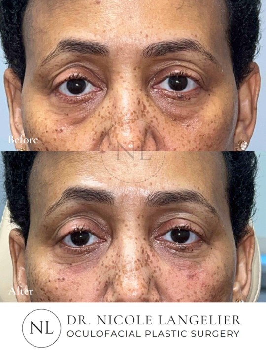 Tear Trough Filler - Immediately After
