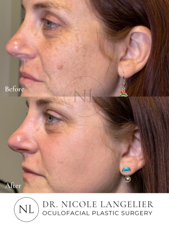 HALO + BBL - 1 Treatment