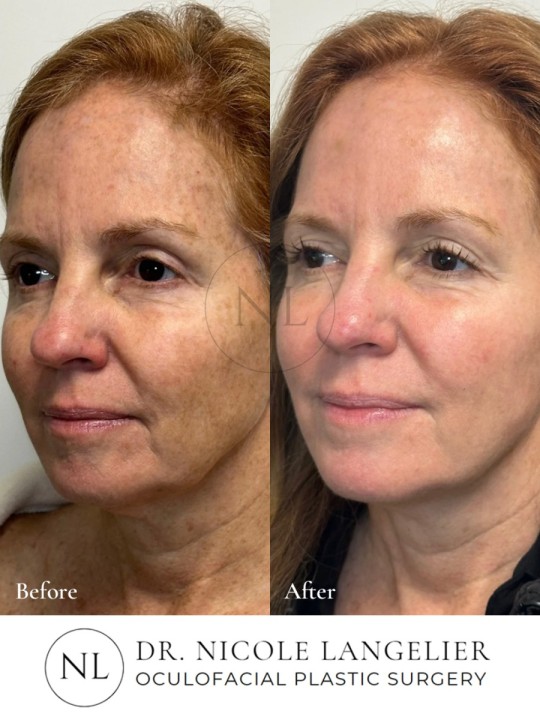 HALO + BBL - 1 Treatment