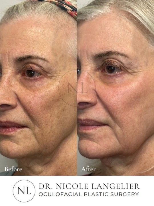 HALO + BBL - 1 Treatment