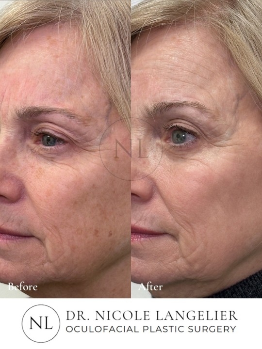 HALO + BBL - 1 Treatment