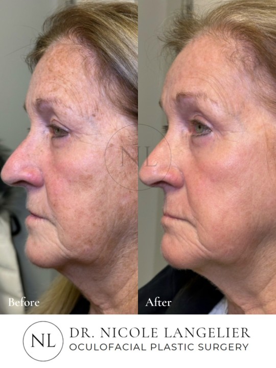 HALO + BBL - 1 Treatment