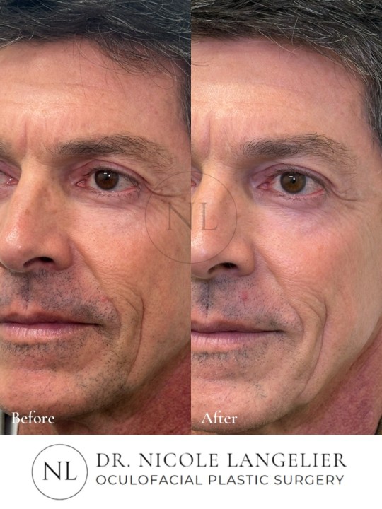 HALO + BBL - 1 Treatment