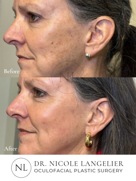 HALO + BBL - 1 Treatment