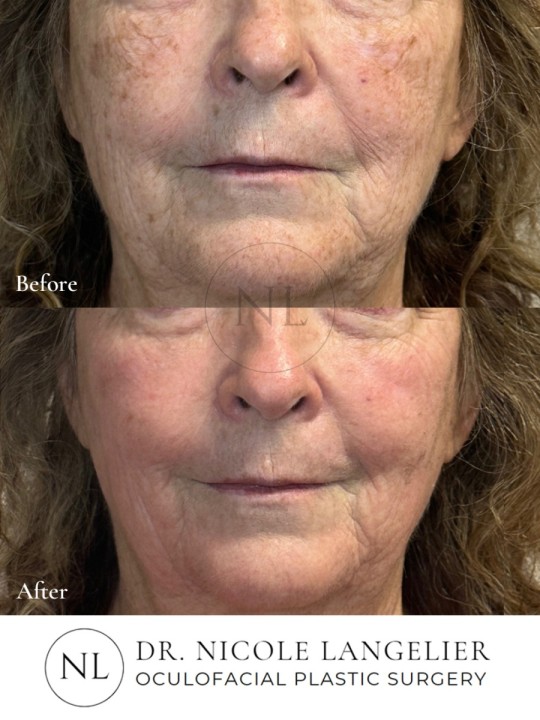 HALO + BBL - 1 Treatment