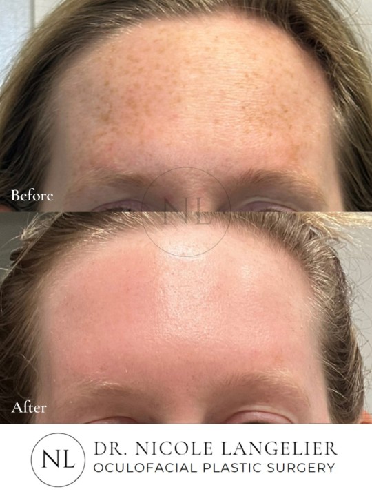 HALO + BBL - 1 Treatment