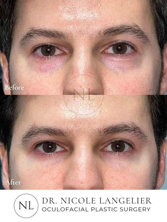 Lower Eyelid Laser Resurfacing