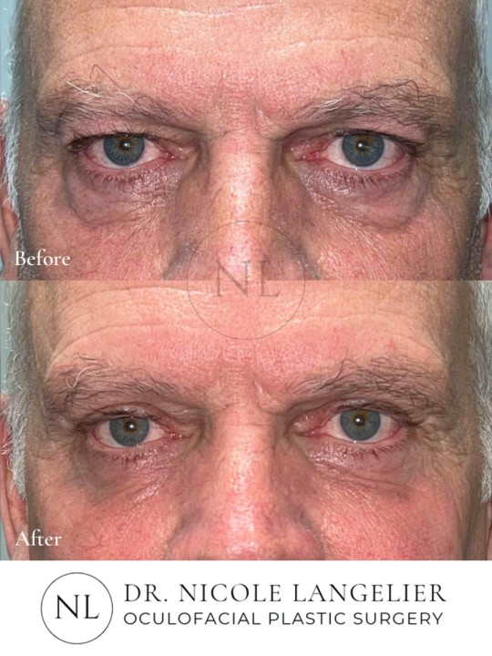 Upper Eyelid Blepharoplasty, Lower Eyelid Blepharoplasty with Fat Transposition and Laser Resurfacing