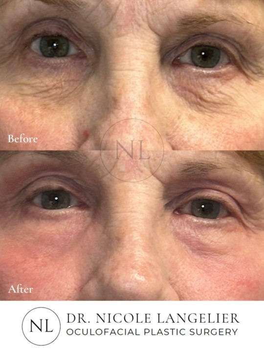 before.after-NAL-4-b