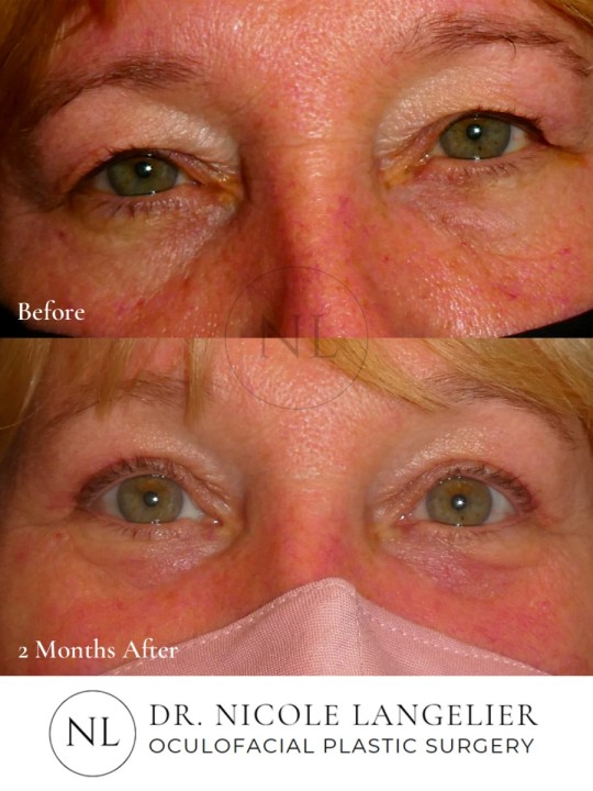 Lower Eyelid CO2 Fractional Laser Resurfacing