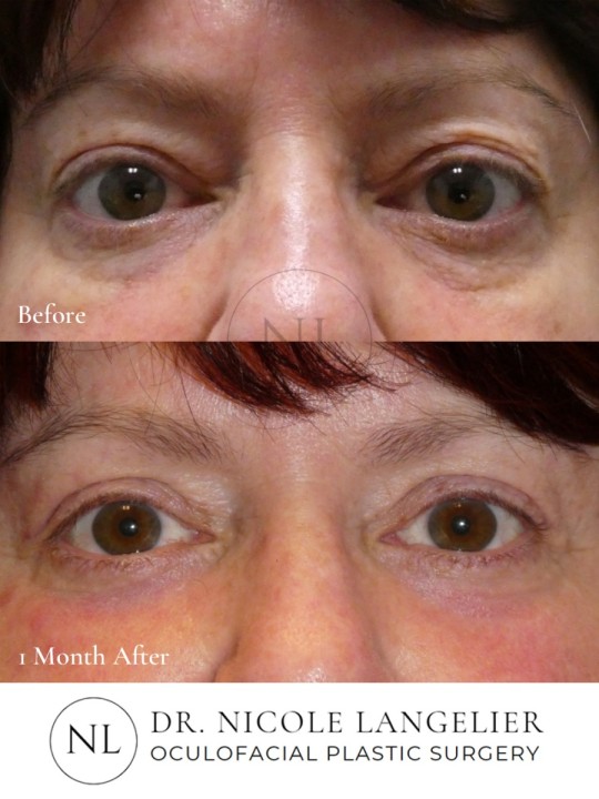 Lower Eyelid Laser Resurfacing